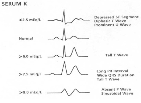 klonopin overdose ekg test results