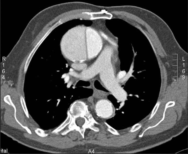 CT Chest: Aortic Dissection (radiopaedia.org)