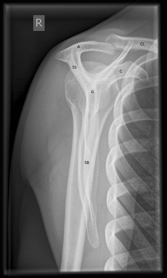 Approach to Traumatic Shoulder Pain – Core EM