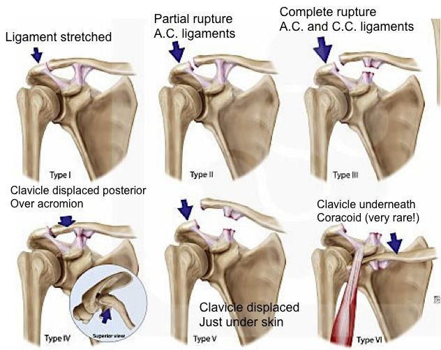 Rockwood Classification System (http://bostonshoulderinstitute.com/patient-resources/modules/ac-joint-injuries/)