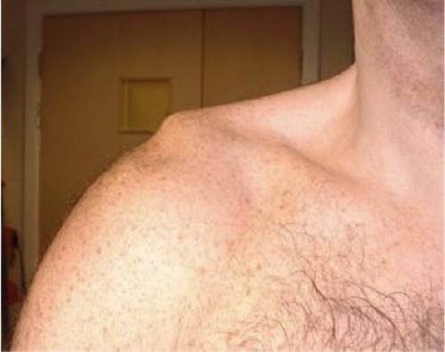 AC Joint Injury (www.shouldersurgery.com)