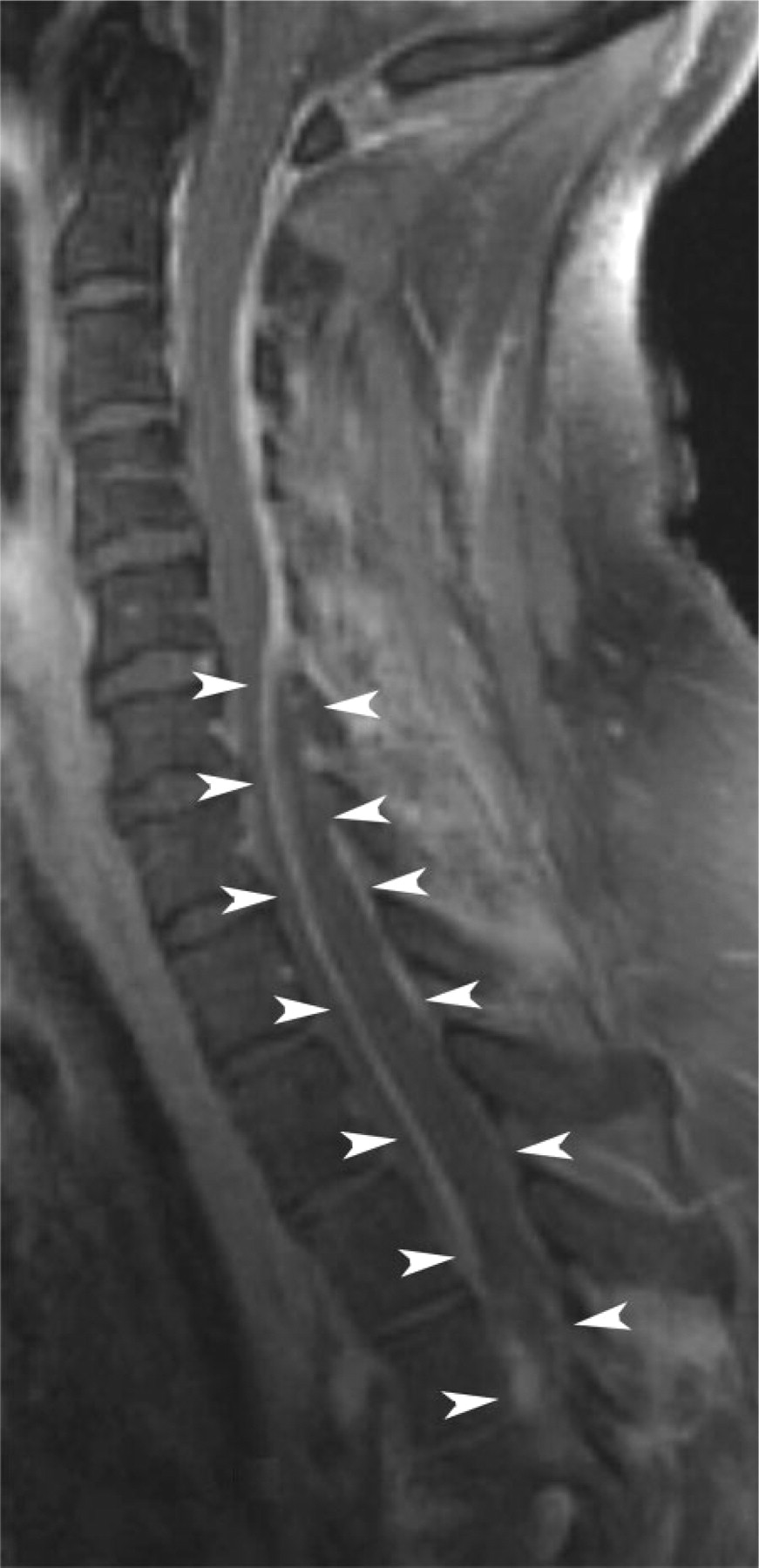 MRI Image of Spinal Epidural Abscess (http://d3gef7ppmbvsns.cloudfront.net/)