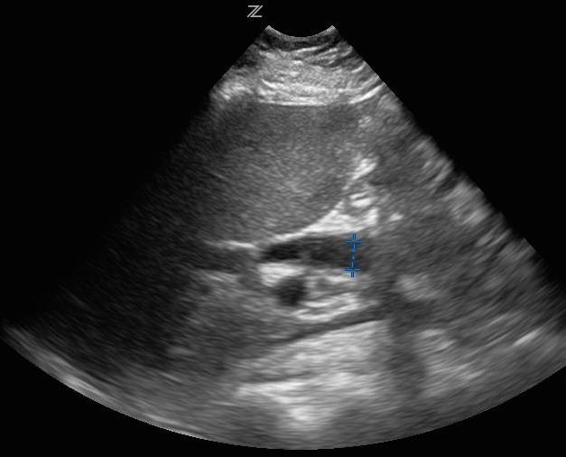Ultrasound with Dilated Common Bile Duct (CBD)