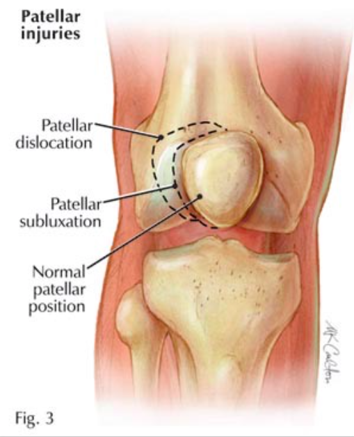 Patellar Dislocations (www.hughston.com)
