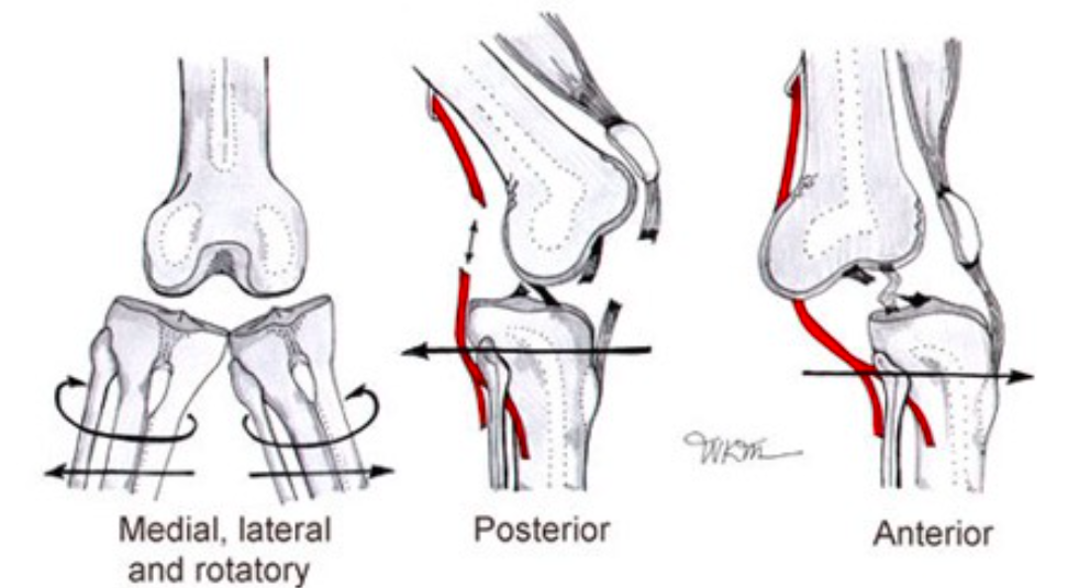 Knee Dislocations (www.emedicinehealth.com)