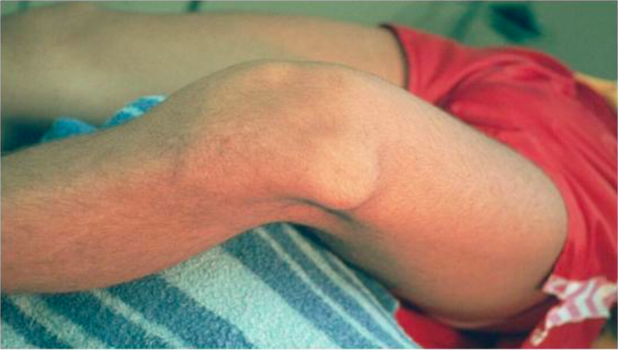 Patella Dislocation (www.exceptyou.org)
