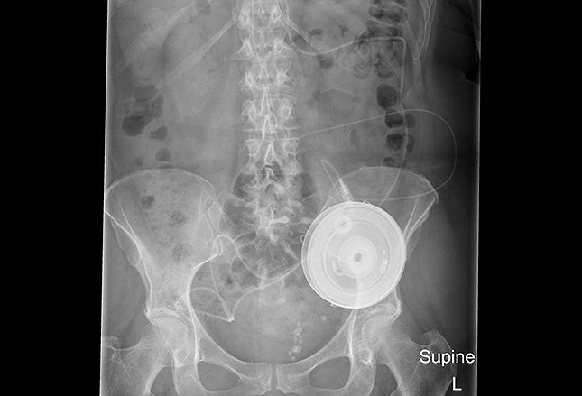 what is an intrathecal baclofen pump