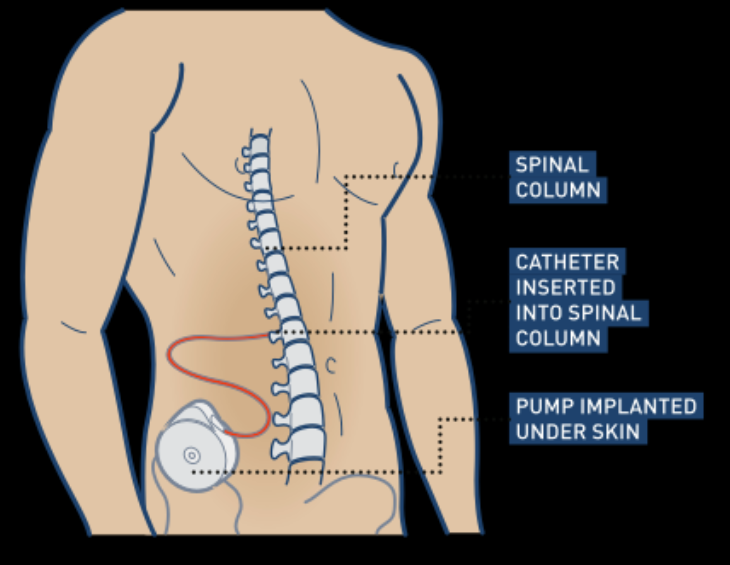 Intrathecal baclofen withdrawal symptoms