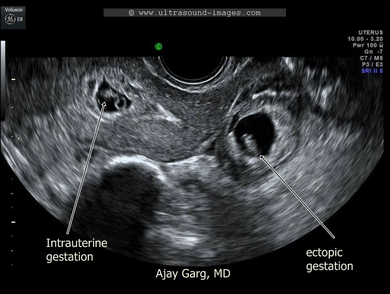 Ectopic Pregnancy Core Em 