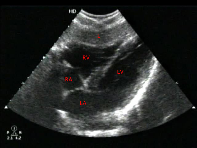Subxiphoid View - Normal