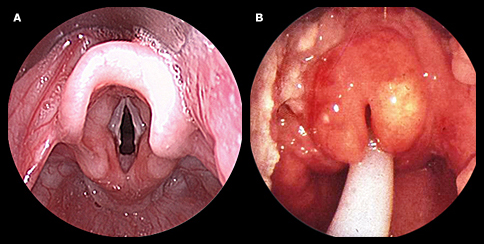Epiglottitis Laryngoscopy