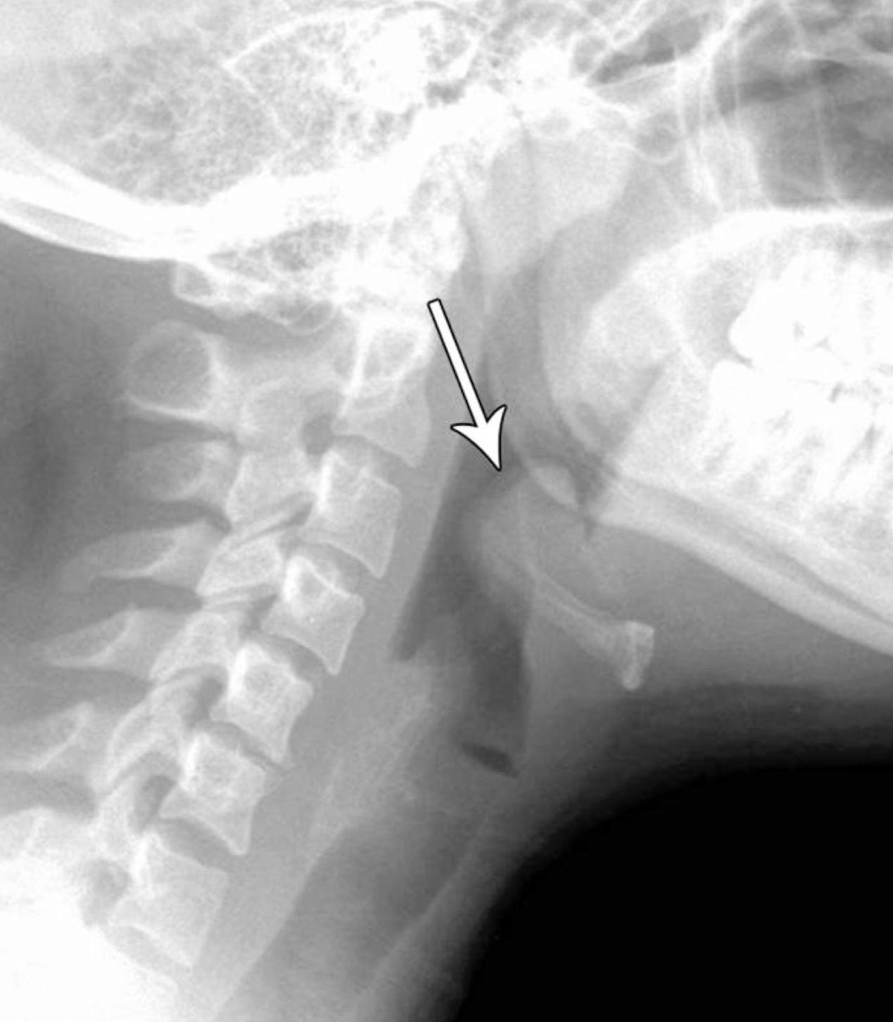 Epiglottitis – Core EM