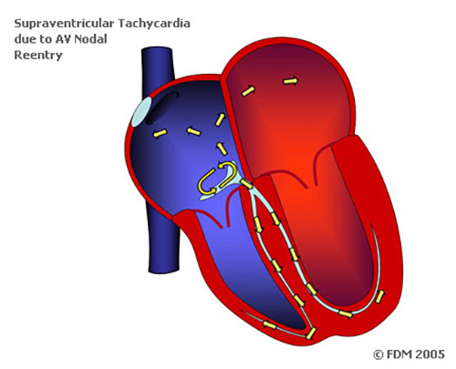 av nodal reentrant tachycardia