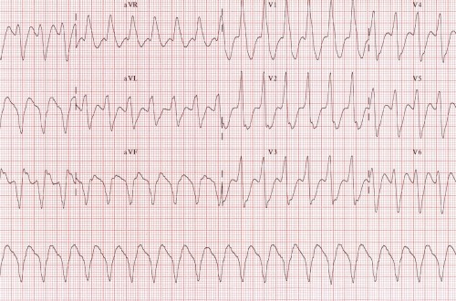 Ventricular Tachycardia – Core EM