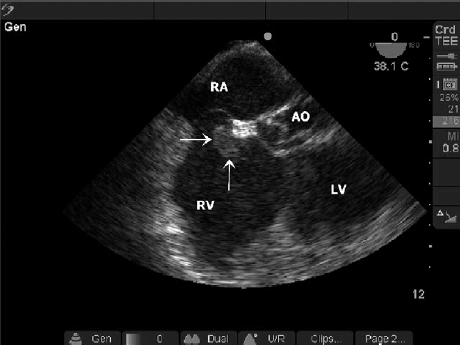 TEE with Thrombus in RA:RV