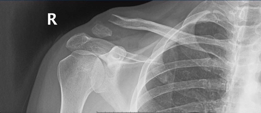 Distal 1/3 clavicle fracture