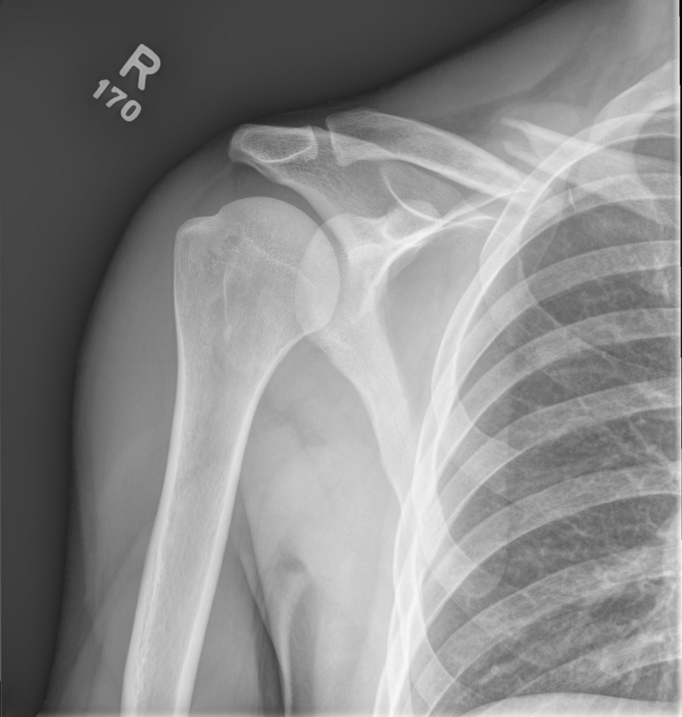 Middle 1/3 clavicle fracture