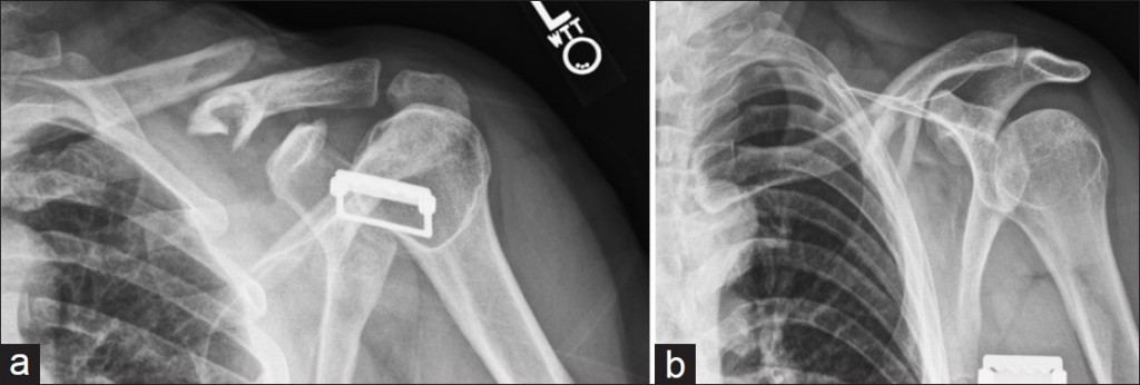 Orthogonal radiographs of clavicle fracture