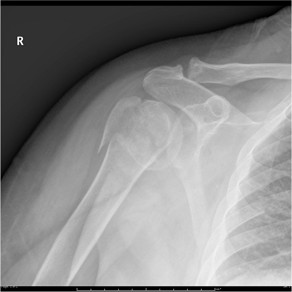 impacted shoulder fracture