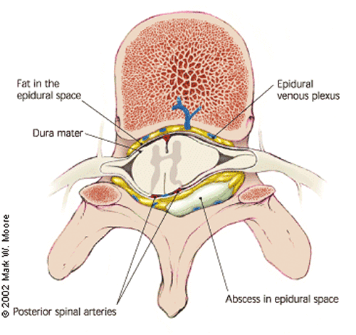 Spinal Epidural Abscess (aafp.org)