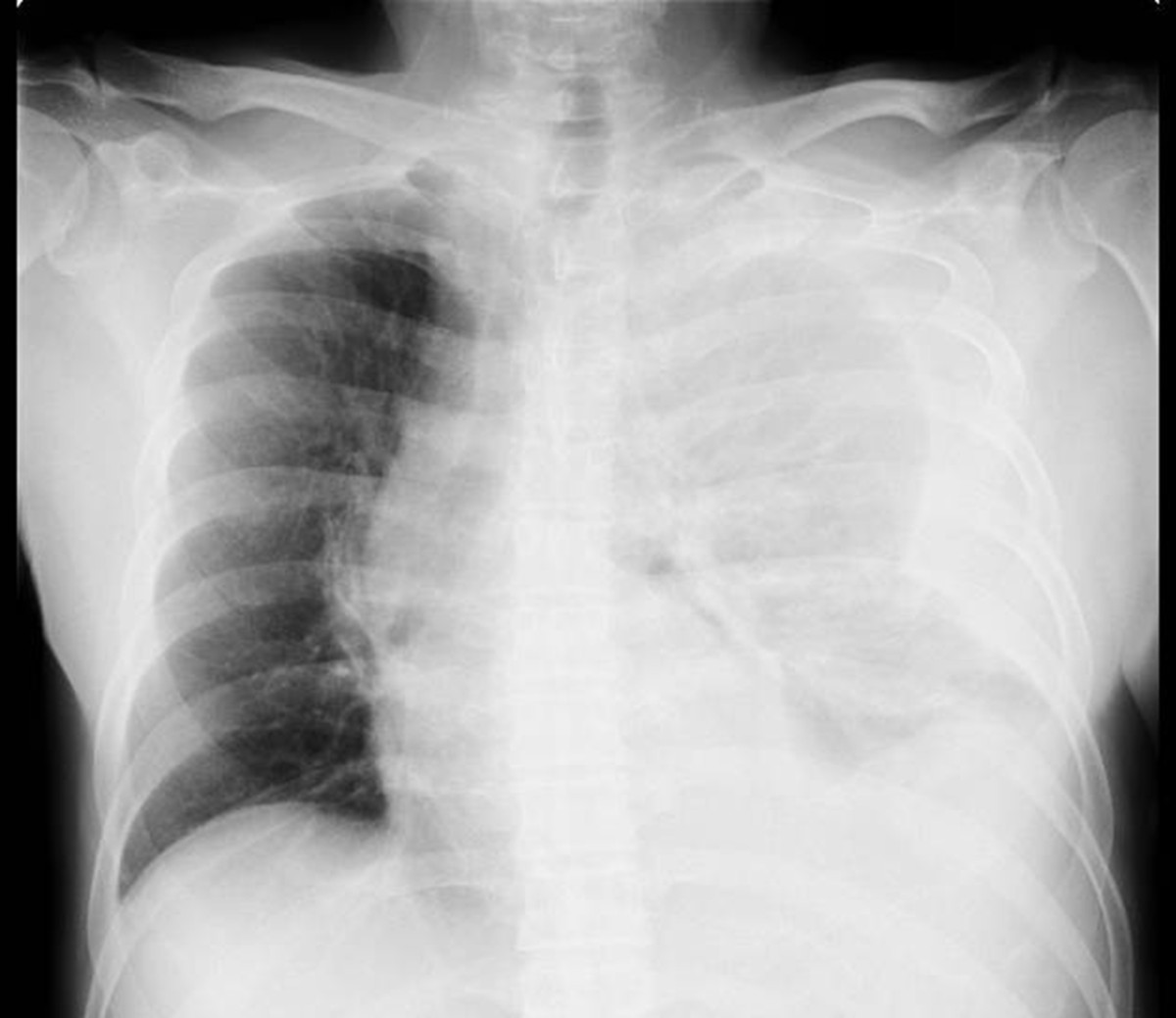 Chest X-Ray Demonstrating Hemothorax - cardiothoracicsurery.org