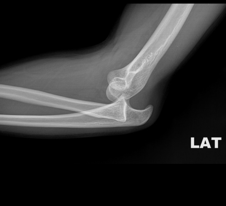 X-Ray: Posterior Dislocation