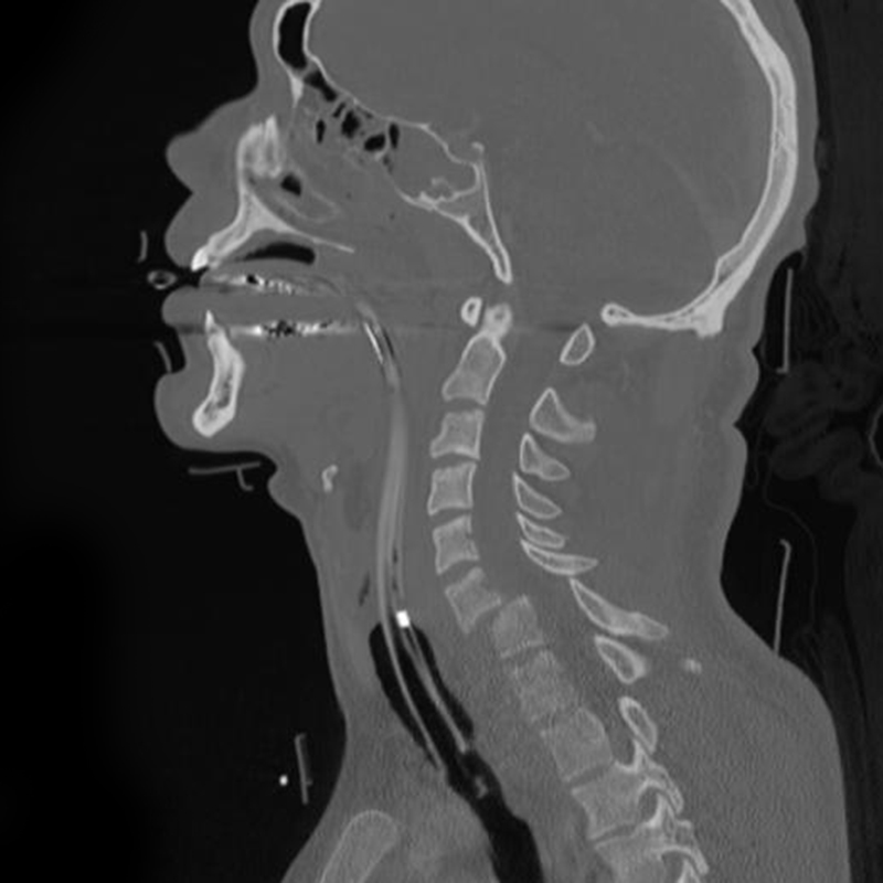 C-Spine Injuries + CT Interpretation – Core EM