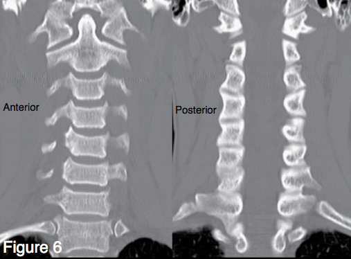 C-Spine CT: Coronal Slices