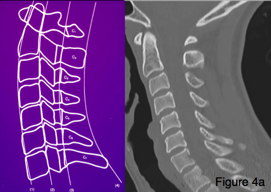 Cervical Spine Alignment