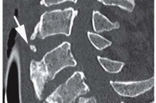 retrolisthesis of spine retrolisthesis of spine