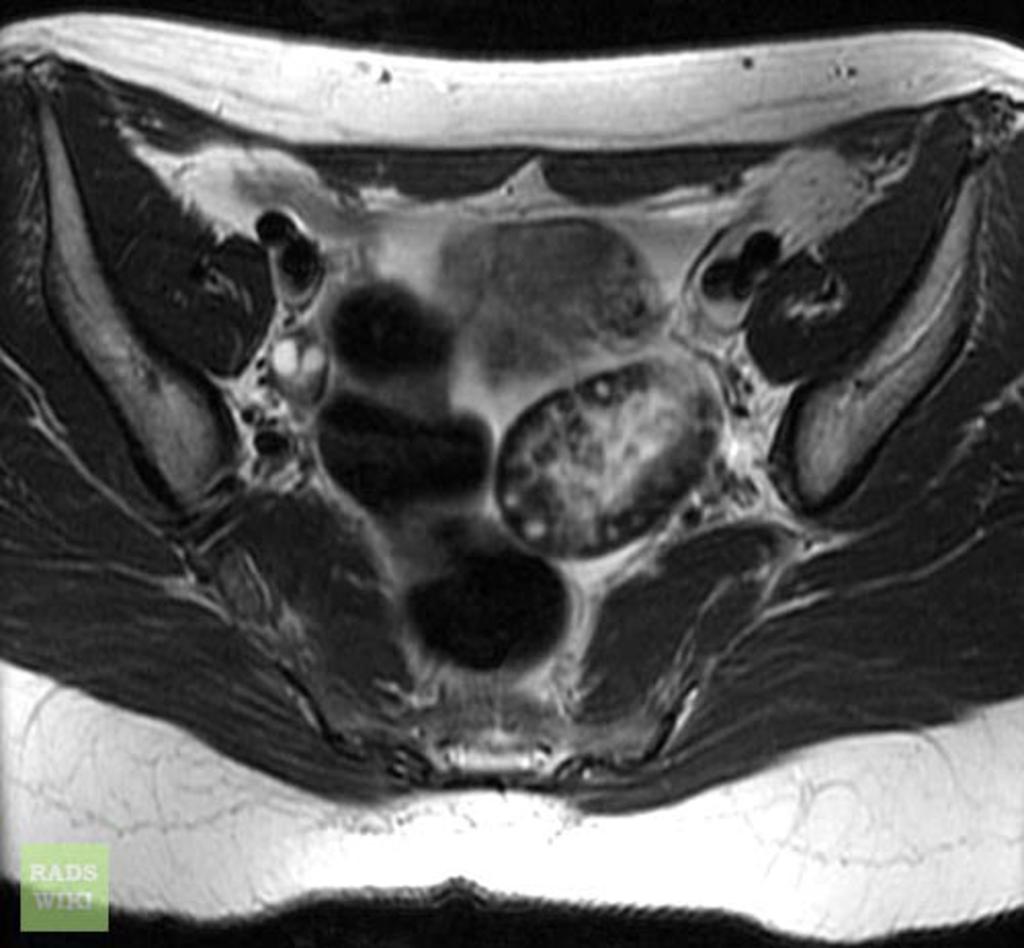 Ovarian Torsion Ultrasound Findings