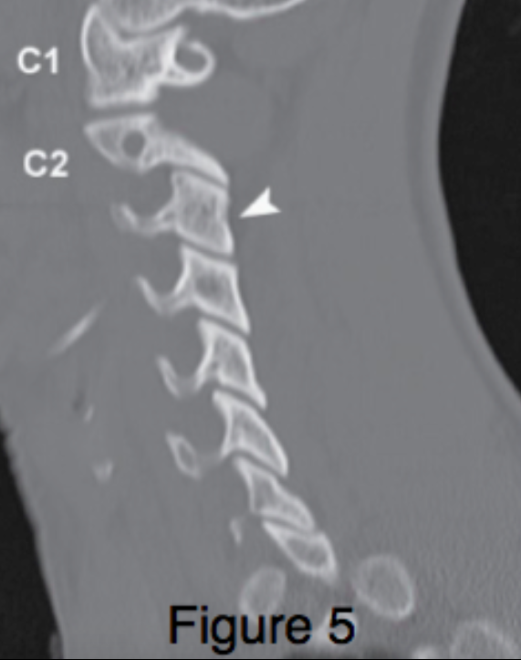CT C-spine: Parasagittal Slice (Figure 5)