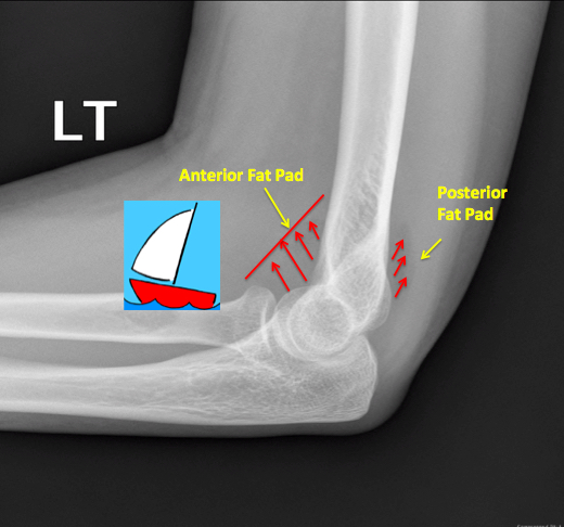 X-ray Elbow: Sail Sign