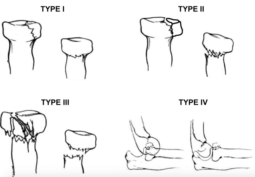 Mason Classification of Radial Head Fractures