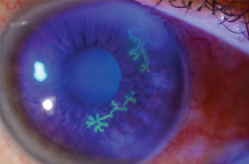 Pic 2 - dendritic lesions optometrist.com.au