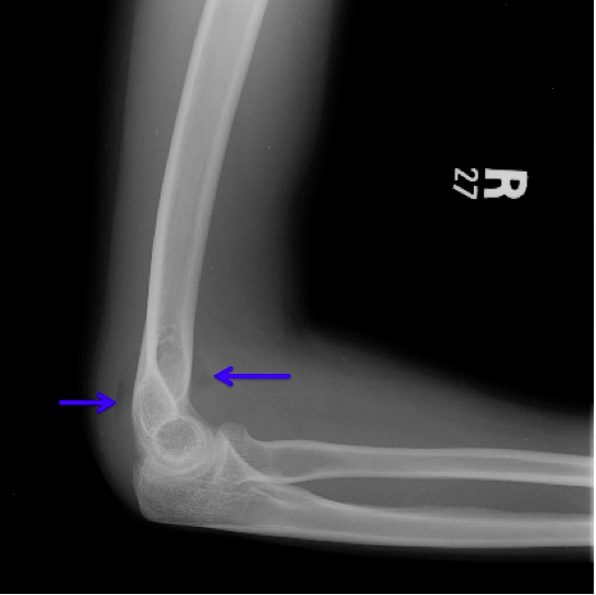 Radial Head Fracture with Sail Sign and Posterior Fat Pad (http://ortho-teaching.feinberg.northwestern.edu/cases/elbow/case2/case16additionalimages.html)