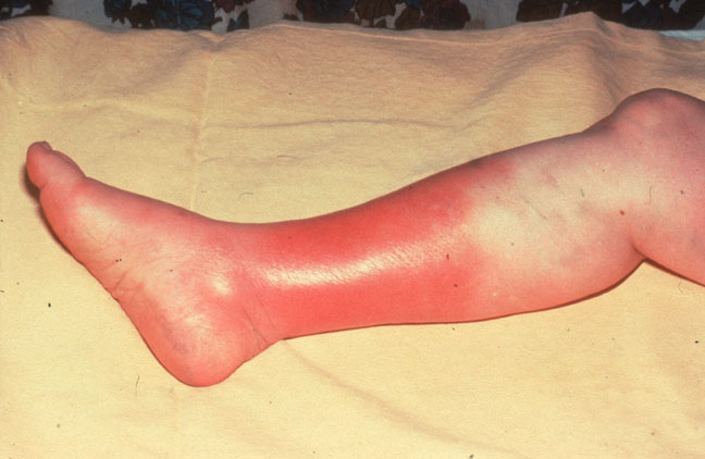 staphylococcus infection on skin