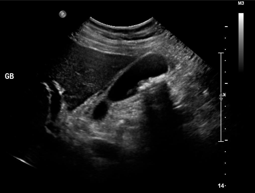 Acute Cholecystitis (Long Axis US) Case courtesy of Dr Hani Al Salam, Radiopaedia.org. From the case rID: 16067