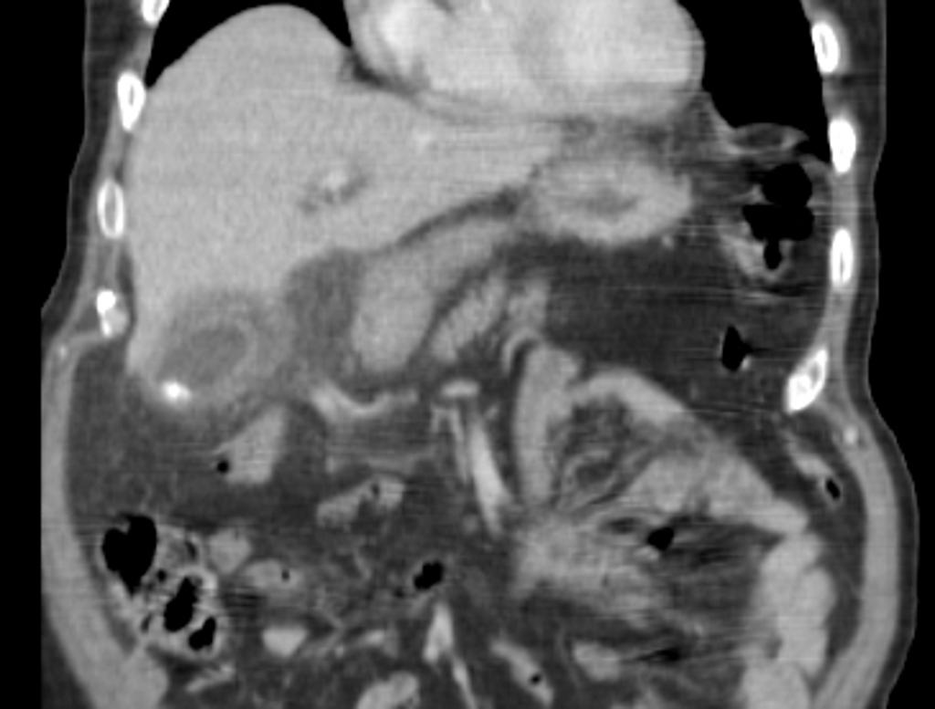 Acute Cholecystitis (CT Scan Sagittal Images) Case courtesy of Dr Hani Al Salam, Radiopaedia.org. From the case rID: 16067