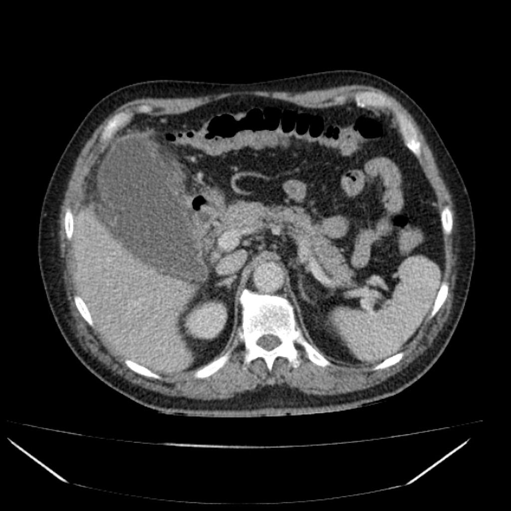 Gangrenous Cholecystitis Case courtesy of Dr David Cuete, Radiopaedia.org. From the case rID: 38882