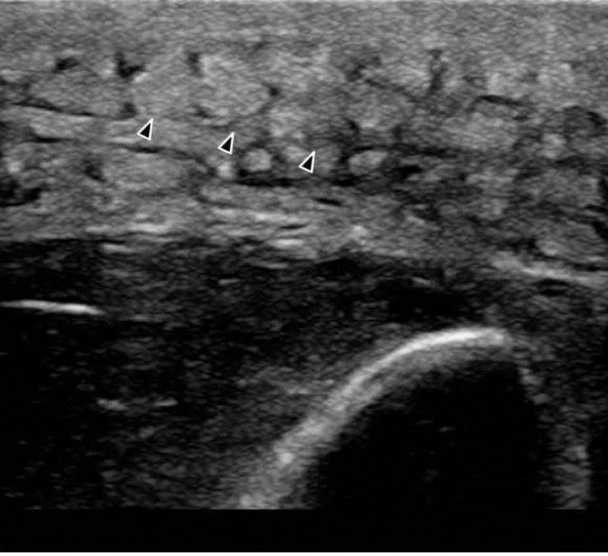 Ultrasound of Cellulitis Showing Edema + Cobblestoning