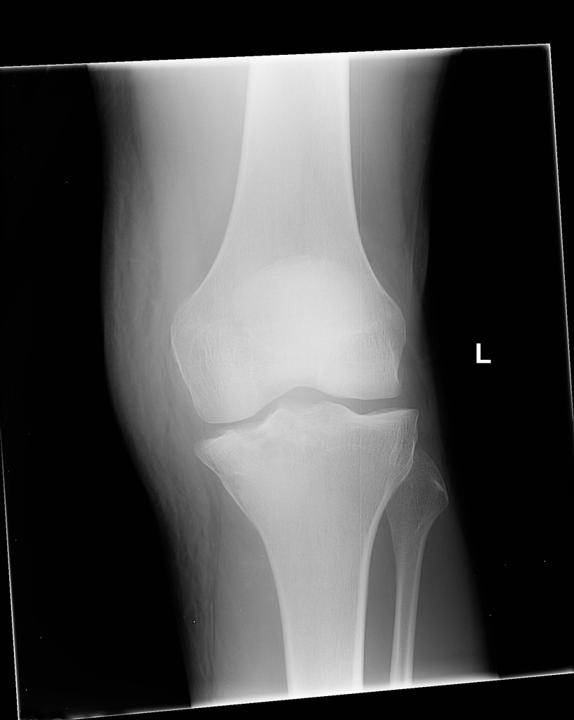 Medial Tibial Plateau Fracture (Case courtesy of RMH Core Conditions, Radiopaedia.org. From the case rID: 33626)