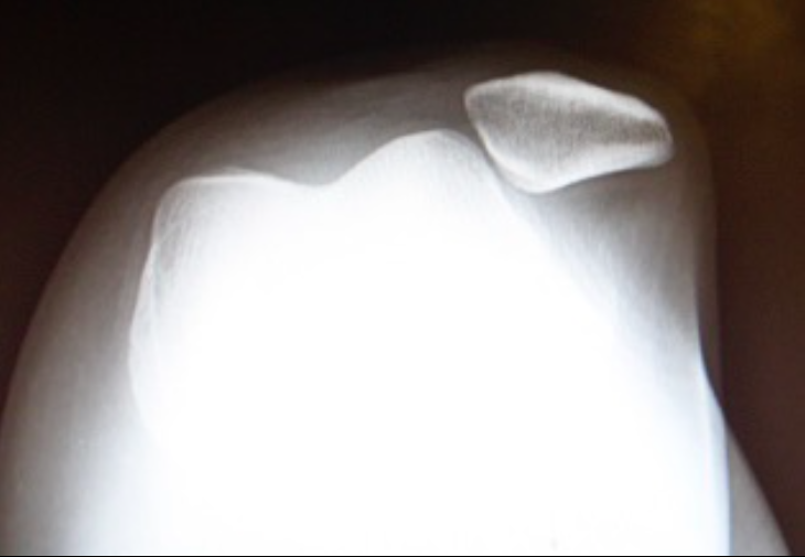 X-Ray Sunrise View Showing Patella Dislocation (drhem.wordpress.com)