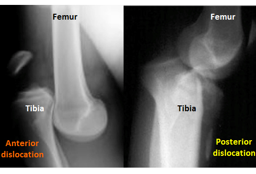 X-Ray: Anterior + Posterior Dislocations (www.bleacherreport.com)