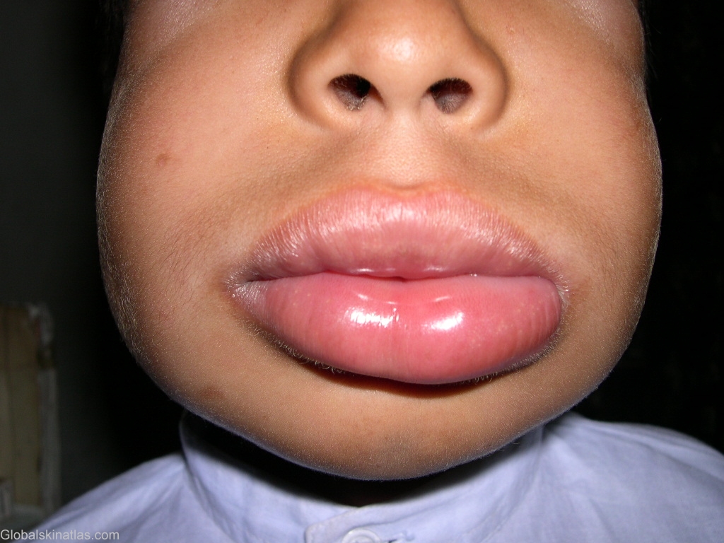 angioedema lips