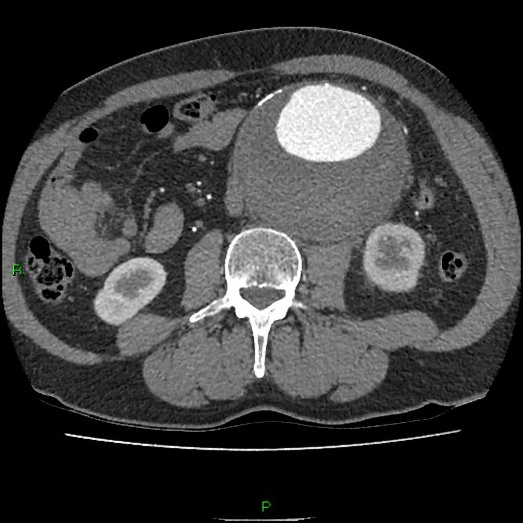 Infrarenal AAA on CT with Contrast (Case courtesy of Dr Derek Smith, Radiopaedia.org. From the case rID: 36556)