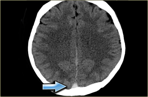 Hyperdensity of Dural Sinus on NCHCT (www.radiologyassistant.nl)