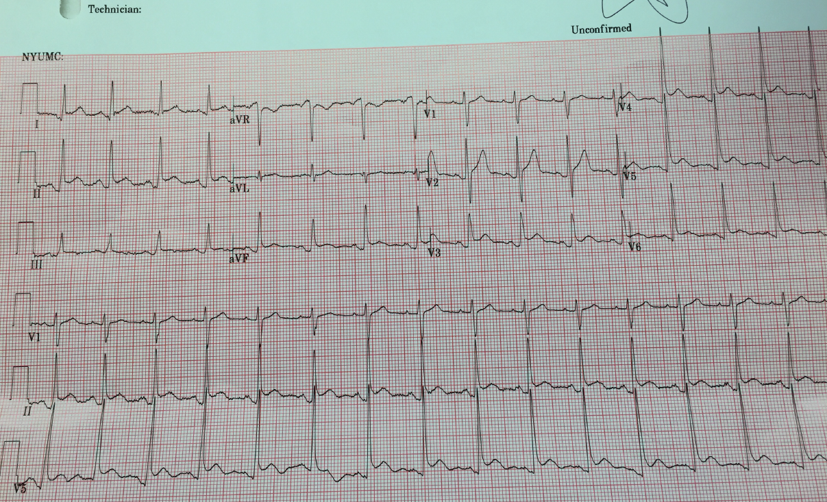 Ecg Changes In Pericarditis