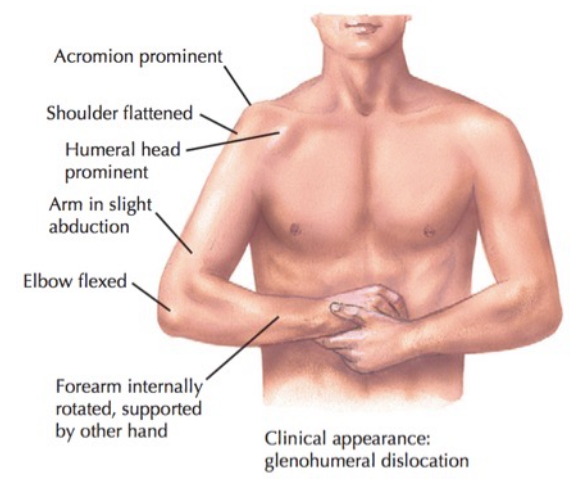 anterior shoulder dislocation