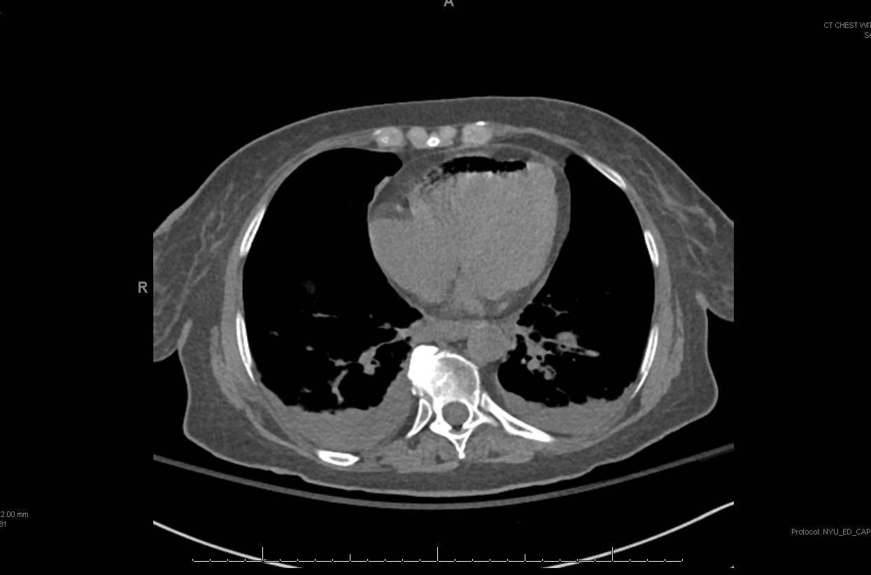CT Chest Showing Air Embolism